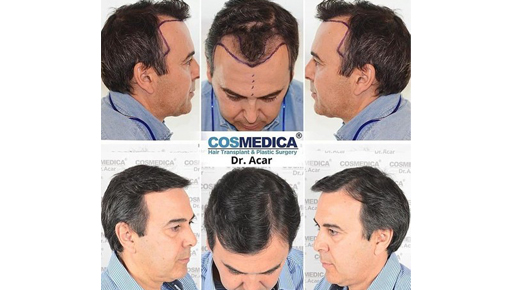 Haartransplantation in Istanbul Bild2