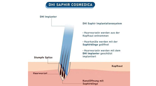 Haartransplantation in Istanbul Bild4