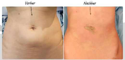 Liposuktion vorher nachher